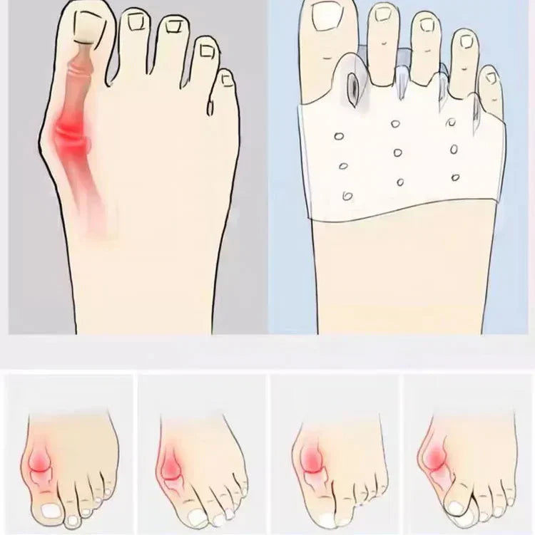 4x Coussinets en Silicone pour l'avant-pied - Alignement des orteils